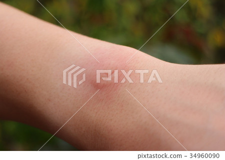 蚊子雄性的手臂 蚊子雄性的手臂 34960090