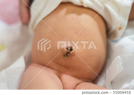 Dry umbilical cord of newborn infant baby 35009458