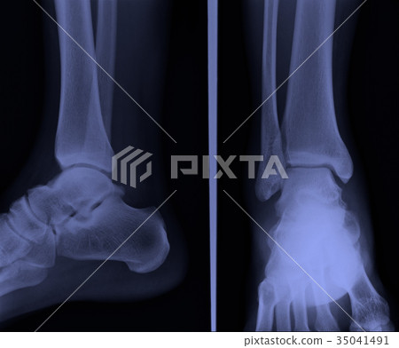 x ray ankle ap lateral 35041491