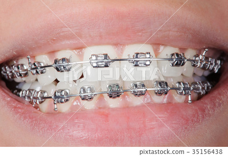 Close-up dental braces on teeth. Orthodontic 35156438
