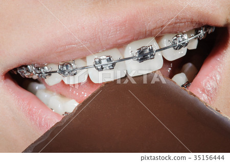 Teeth with dental braces biting chocolate 35156444