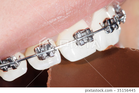 Teeth with dental braces biting chocolate Teeth with dental braces biting chocolate 35156445