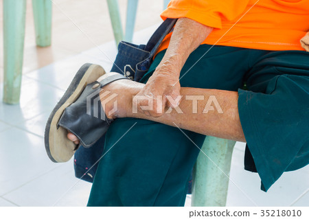hand of old asian man suffering from leprosy hand of old asian man suffering from leprosy 35218010