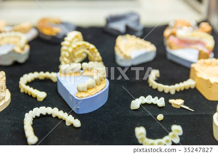 Denture treatment, dental implants closeup Denture treatment, dental implants closeup 35247827