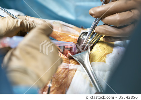 Abdominal operation process 35342850