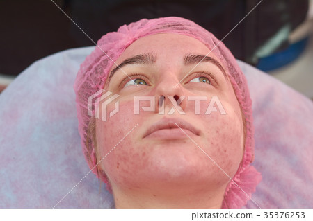 Face of young woman, acne. 35376253