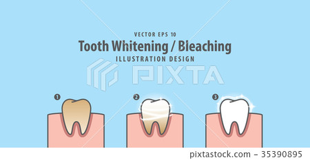 Step of single tooth Whitening-Bleaching vector Step of single tooth Whitening-Bleaching vector 35390895