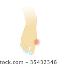Hallux valgus 35432346