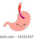 Reflux esophagitis 35432347