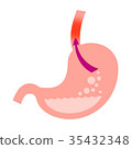 Reflux esophagitis 35432348