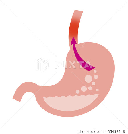 Reflux esophagitis Reflux esophagitis 35432348