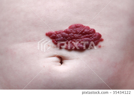 Capillary hemangioma red birthmark on the baby's 35434122