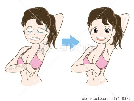 Esthetic / Women's unwanted hair treatment / Before after 35438382