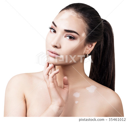 Portrait of beautiful woman with vitiligo. Portrait of beautiful woman with vitiligo. 35461012