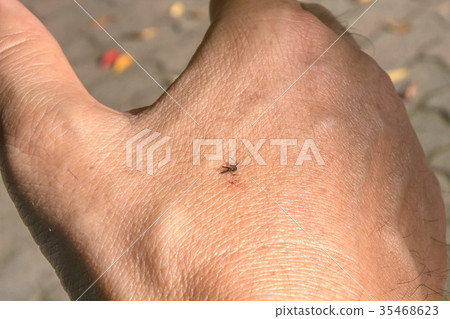 昆蟲叮咬 35468623