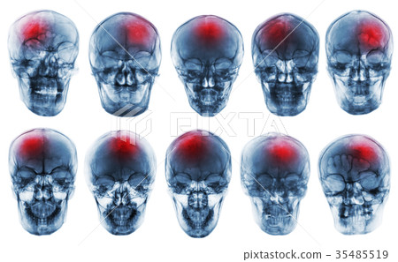 Stroke . Cerebrovascular accident . Stroke . Cerebrovascular accident . 35485519
