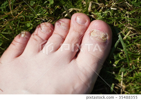 Onychomycosis. Fungal infection of nails of feet 35488355