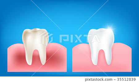 Collection of dirty tooth and gum compare with  35512839