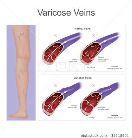 Varicose veins. 35518901