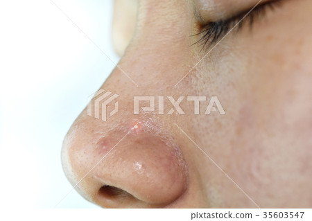 Skin problem with acne diseases. Skin problem with acne diseases. 35603547