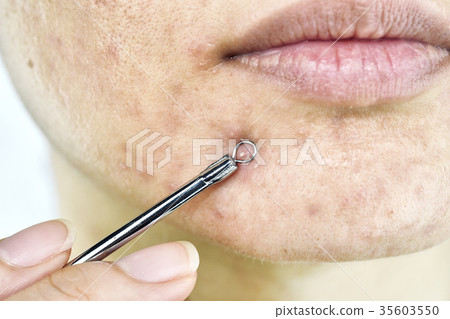 Skin problem with acne diseases. Skin problem with acne diseases. 35603550