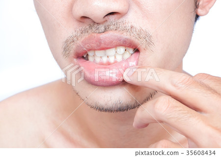 Lips man problem health care, Herpes simplex 35608434