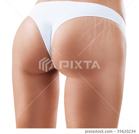 Female buttocks with stretching marks. 35620234