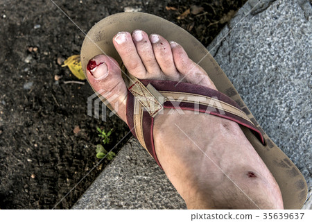 Accident flip flop cut foot nail toe have a bloody Accident flip flop cut foot nail toe have a bloody 35639637