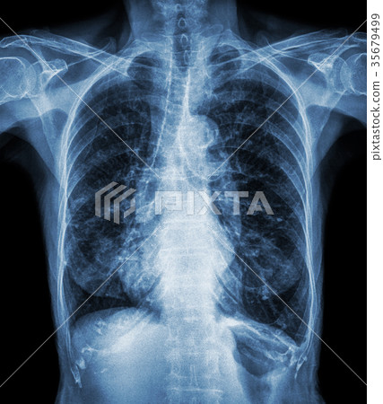 Normal chest X-ray of old patient . 35679499