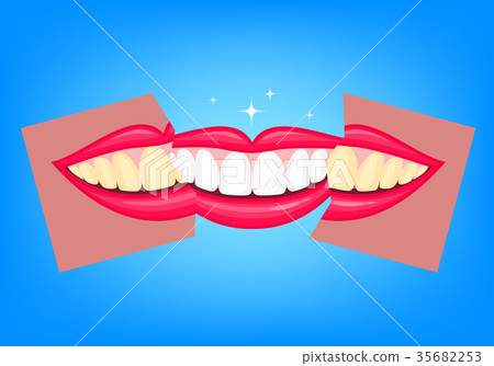 Whitening teeth, before and after.  35682253