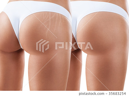 Hips with scars before and after treatment. 35683254