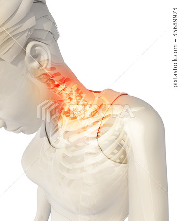 Neck painful - cervical spine, 3D illustration. 35689973