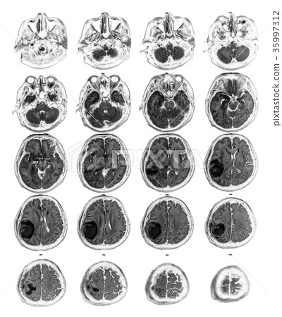 MRI brain show Brain tumor at right parietal lobe 35997312