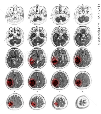 MRI brain show Brain tumor at right parietal lobe MRI brain show Brain tumor at right parietal lobe 35997313