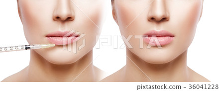 woman getting injection on lips. woman getting injection on lips. 36041228