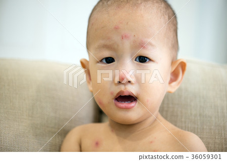 Asian baby boy with chicken pox Asian baby boy with chicken pox 36059301