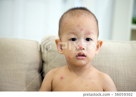 Baby boy with chicken pox on couch Baby boy with chicken pox on couch 36059302