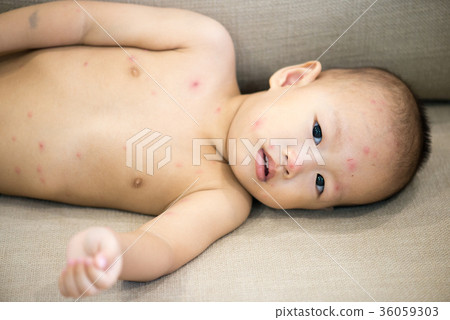 Baby boy with chicken pox lying on sofa Baby boy with chicken pox lying on sofa 36059303