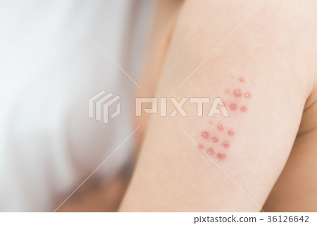 Vaccination mark 36126642
