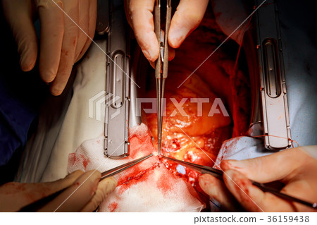 Surgeon hands are tying a knot during  36159438
