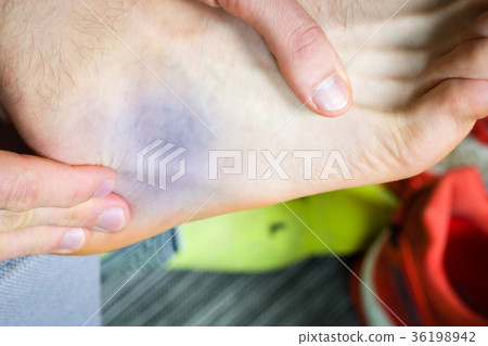 Bruise near ankle, common runners contusion. Bruise near ankle, common runners contusion. 36198942