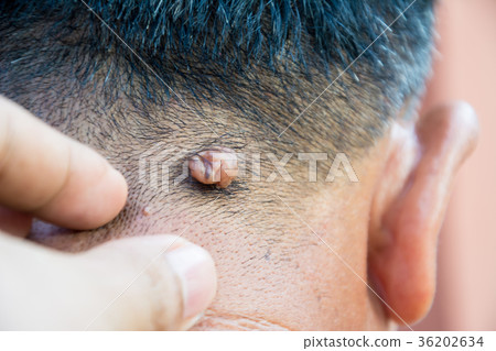 Mole on the skin of the body on human 36202634