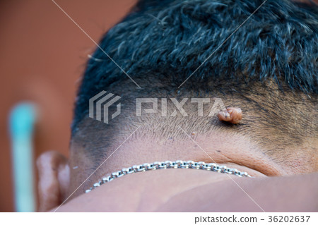 Mole on the skin of the body on human 36202637