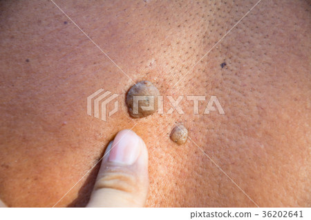 Mole on the skin of the body on human 36202641