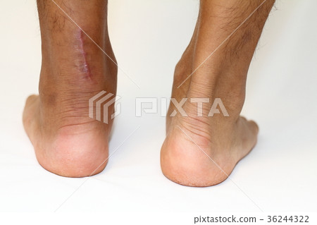 Achilles tendon suture surgery scar 36244322