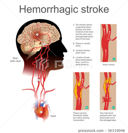 Hemorrhagic stroke. 36319046