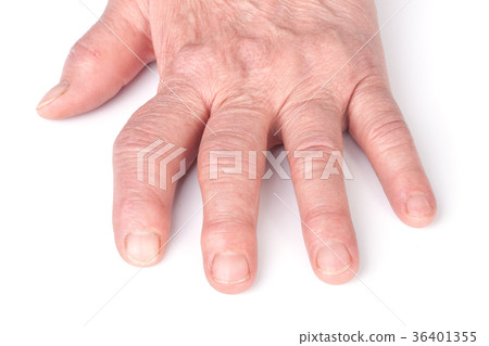 Rheumatoid polyarthritis of hands isolated on 36401355