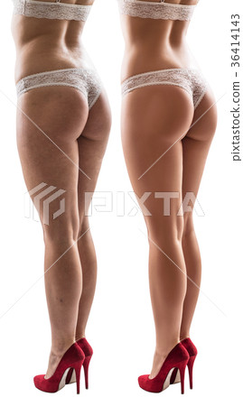 Female buttocks before and after treatment. Female buttocks before and after treatment. 36414143