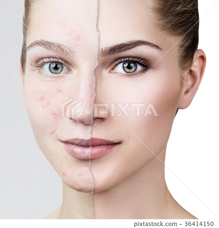 Compare of old photo with acne and healthy skin. 36414150