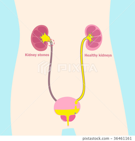 kidney with healthy problem 36461161